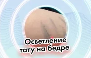 Осветление тату на бедре